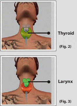 Thyroid cancer