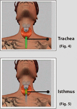 Thyroid cancer